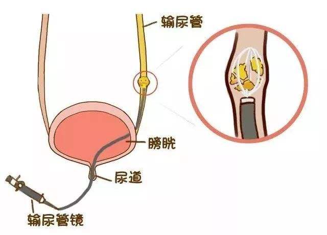 雅安结石病治疗6