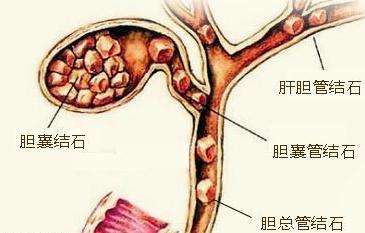 雅安结石病治疗9