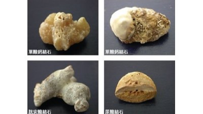 结石治疗最佳方案