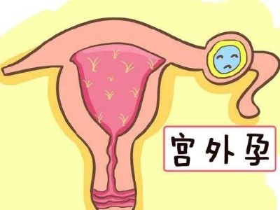 宫外孕（异位妊娠）