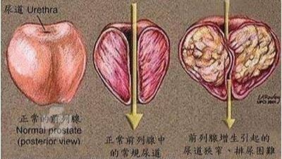 前列腺增生