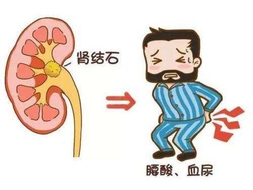 肾结石有什么症状